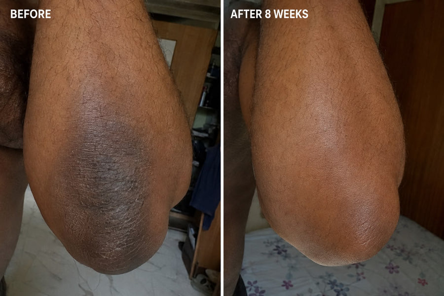 Haldayne before and after 8 weeks - elbow